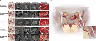 Pituitary adenoma with cavernous sinus compartment penetration and intracranial extension: surgical anatomy, approach, and outcomes